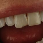 Anthea Turner Instagram – Awwwww!!
At the most inopportune moment just before I set out for the Galapagos, where I am now, a piece chipped off my front tooth 🦷
Thank you my lovely friend Dr Safa for seeing me at such short notice and saving the day.
I don’t have any veneers but Dr Safa advised me 2 years ago to strengthen up my edges, but like so many of us without thinking I hold my keys in my mouth while pulling shopping bags out of the car, bite packets open and all sorts of other thing not recommended.
All fixed now and ready to bite again!!
@dr_safa_alnaher_arabic
@serene_dental_aesthetics