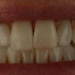 Anthea Turner Instagram – Awwwww!!
At the most inopportune moment just before I set out for the Galapagos, where I am now, a piece chipped off my front tooth 🦷
Thank you my lovely friend Dr Safa for seeing me at such short notice and saving the day.
I don’t have any veneers but Dr Safa advised me 2 years ago to strengthen up my edges, but like so many of us without thinking I hold my keys in my mouth while pulling shopping bags out of the car, bite packets open and all sorts of other thing not recommended.
All fixed now and ready to bite again!!
@dr_safa_alnaher_arabic
@serene_dental_aesthetics