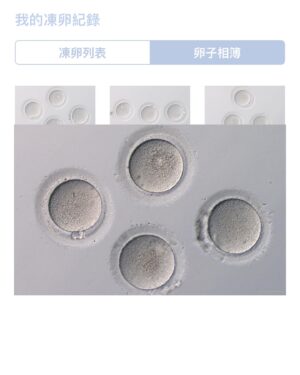Cammy Chiang Instagram - “我想做那個有選擇的人。”
 
因為我無法篤定的說：「我不要生小孩。」
對於未來的我會有什麼想法實在是太捉摸不定了。光是目前的我和20歲的我就已經差了十萬八千里。總是很愛後悔的我，先給自己留選擇的餘地。當作多一個機會。用不用我覺得是其次。
 
我希望如果有那天，自己有足夠的能力，讓小生命體會這世界的美好。
「你想要小孩嗎？你想要結婚嗎？你的事業穩定了嗎？你有遇到好對象嗎？你準備好放棄很多自由了嗎？你夠成熟嗎？你經濟負擔得起嗎？你幾歲會準備好？你的對象幾歲會準備好？你真的還想要小孩嗎？你身體要有很大的變化了你確定嗎？你要當媽媽嗎？你適合當媽媽嗎？你有該有的資源幫助嗎？你情緒穩定嗎？」
 
秉持著負責任的心態，我覺得如果我沒有準備好，我不會帶新生命到這世上，畢竟這個世界是如此的不容易。
 
第一次去送子鳥生殖中心，諮詢凍卵相關的資訊，測出ＡＭＨ值（抗穆勒氏管激素，卵巢庫存指標）4.1，正式做的那個月是3.4（上下起伏是正常），依然讓本來悠哉的我非常緊張。本來前期觀察的初始濾泡顆數比預期數量來的少，心情跟著上上下下，最後幸運的結果比預期好。
但這個過程也讓我瞥見，女性生育的不易之處，對生理心理都有不小的影響。
 
本來以為31歲取卵應該還是偏早，沒想到和胚胎師聊過後得知，其實不算早，有1/3年輕女性有卵巢庫存問題，我的年齡通常平均AMH有3以上，1/3的人沒有達到。 因現代社會工作壓力大，健康飲食作息基本上很困難。我的工作作息不固定又是高壓，心理影響生理，感覺身體耗損蠻快。早一點凍，自己也比較安心。所以有計劃或和我一樣游移不定的大家可以先來驗一下ＡＭＨ值。 
 
很多人擔心未來會不會用不到的問題，其實，現代大部分人晚婚晚生，即使第一胎用不到，也可以在二胎的時候使用。 越年輕存的卵，解凍存活率越高。並且35歲以下女性，15顆卵有9成機率可以活產一個健康寶寶，雖然沒有百分百成功率，但總是讓自己多一個機會。
 
我想做那個有選擇的人，所以我一點都不覺得打針痛，想要就去做。這種無法無中生有的事情，對我來說有準備就是有準備，沒準備就是沒準備，至少我努力過了。
說實話，我更不願意給同為女性的同胞帶來壓力。每個人都有自己對人生的追求，說到底自己的人生想怎麼過真的不關別人的事。所以大家要練習，想問候別人子宮的時候，先停個三秒，然後把話吞下去，因為不關你的事。
 
這是一篇充滿矛盾，自我辯論的文章，每一段都在改變觀點，就像人生一樣。
 
特別感謝送子鳥，全程令人安心的解說和貼心細膩的服務，過程中有對身體的改變或者不適都可以用line詢問得到解答。 第一次去參觀胚胎室外圍的時候，隨口問了：那個冷凍的乾冰跟美國隊長用的是同一種嗎？ 竟然！竟然連這麼隨口的問題都認真看待，還特地詢問給了我解答。（我有道歉了，對不起不小心浪費醫療資源）。總之術前術後得到了滿滿的安全感和照顧。相信我的卵子也以最好的身心狀態？跟美國隊長一樣被冷凍的很安穩。謝謝送子鳥的醫護人員，謝謝金孜璇醫師全程的專業照護和手術，謝謝李雯coco胚胎師的詳細耐心講解。
 
 
 在短短幾周內體驗到
有腰線➡️沒腰線➡️肚子變圓➡️手術前睡覺會卡到硬硬的肚子➡️肚子變圓➡️沒腰線➡️慢慢回復到有腰線的過程
不僅感嘆人體的神奇，原來真的會忍不住一直摸肚子，坐下發出艱難的嘆氣也是真的（這個狀態只有兩天不用擔心）
 
母親們真的太偉大了，十月懷胎，才有了我們。
謝謝所有勇敢的母親們，謝謝送子鳥送給母親們最珍貴的禮物。
 
 #送子鳥生殖中心
@stork.tw @stork.icryo