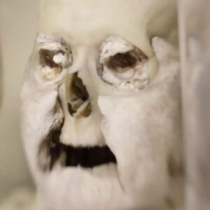 Carla Valentine Instagram - Hmmm, I wonder if I can get the phrase "Steve the Beef" into a post? Yes I can indeed! Read on...
Adipocere: This gentleman is from the Forensic Collection at the Pathology Museum, dated around 1960s/70s and was discovered in the septic tank of a housing estate. The pathologist/police posited that perhaps he was the murder victim of a London gang rivalling The Krays. A reason for that theory is his teeth were purposely knocked out, thereby making ID very difficult - typical gang MO. This is a dry skull but it's preserved as what we call a 'wet specimen' in Kaiserling fluid as it has adipocere clinging to it. Adipocere - which literally translates into 'fatty wax' from the Greek 'adipose' meaning fat and 'cera' meaning wax - is a "soapy, waxy" substance which occurs in the deceased when the fat or adipose tissue of the body undergoes a process called 'saponification'. That process litterally means 'to turn into soap', although you wouldn't want to wash with it! I'd call it 'caseous' really, which means 'cheesy') Just as an aside, the actor Micheal Cera translated is Michael Wax, in the same way that Shia LaBeouf can be translated as "Steve the Beef" 😂 Anyway, this process usually happens if there is a high moisture content in the environment during decomposition, and can be useful to forensic investigators as it can preserve the tissue underneath. On a more serious note, and very sadly, it happens to dead babies frequently because they have a higher fat. #adipocere #forensics #forensicscience #pathology #pathologymuseum #anatomy #anatomicalmuseum #anatomymuseum #histmed #wetspecimen #conservation #pottedspecimen #michaelcera #shialabeouf