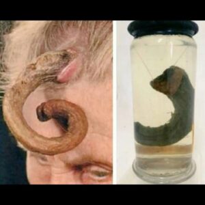 Carla Valentine Instagram - Pop quiz! Apologies for the poor quality of the photo I took, but I've not been at the museum much recently and had to use an old image. Does anyone know what this potted specimen is?
•
It's a "human horn!" (Yes, I thought of Futurama too...)
The medical name for this condition is a cutaneous horn, as cutaneous means "relating to or affecting the skin", and in Latin it's Cornu Cutaneum. 
It may also be called a keratin horn because these unusual growths are made from keratin, which is the same substance that makes up hair & nails in humans, and the oesophagus of rats. They are often benign but can sometimes be malignant and their cause is still unknown. Because they more commonly appear on the face, ears and backs of hands, and in those with fair skin, it's been suggested that there may be a connection with exposure to sunlight but there's also a theory they are related to the wart causing virus HPV. They can be removed fairly easily for those with access to a decent medical system. 
•
As you can see from the 2nd slide, there are still people suffering from this affliction and it's not an archaic condition. The woman in the picture is a 69 yo who watched this horn develop over a period of 20 years. At the time this pic was taken the horn was 17cm long and was removed under general anaesthetic.
•
You can see from the final image that @muttermuseum in Philadelphia has an example of this in the form of a wax moulage. The woman depicted was called Madame Dimanche and she lived in 19th century France. Her horn was 25cm long!
•
We had a sudden period of "summer" here in the UK over the last fortnight so, if these horns are linked to sun damage, this is your reminder to always wear SPF, and if you have any unusual growths or moles that have recently changed in appearance, go and get it checked out! 
•
#cutaneoushorn #medicine #medicalmuseum #pathology #muttermuseum #mutter #protectthemutter #histmed #pathologymuseum #wetspecimen #humanremains #skincancerawareness