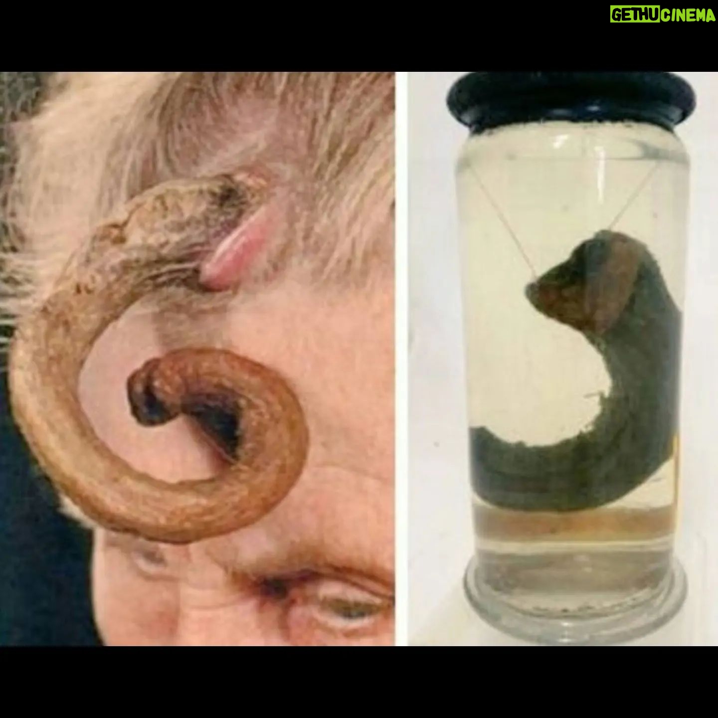 Carla Valentine - 515 Likes - Pop quiz! Apologies for the poor quality of the photo I took, but I've not been at the museum much recently and had to use an old image. Does anyone know what this potted specimen is?
•
It's a "human horn!" (Yes, I thought of Futurama too...)
The medical name for this condition is a cutaneous horn, as cutaneous means "relating to or affecting the skin", and in Latin it's Cornu Cutaneum.
It may also be called a keratin horn because these unusual growths are made from keratin, which is the same substance that makes up hair & nails in humans, and the oesophagus of rats. They are often benign but can sometimes be malignant and their cause is still unknown. Because they more commonly appear on the face, ears and backs of hands, and in those with fair skin, it's been suggested that there may be a connection with exposure to sunlight but there's also a theory they are related to the wart causing virus HPV. They can be removed fairly easily for those with access to a decent medical system.
•
As you can see from the 2nd slide, there are still people suffering from this affliction and it's not an archaic condition. The woman in the picture is a 69 yo who watched this horn develop over a period of 20 years. At the time this pic was taken the horn was 17cm long and was removed under general anaesthetic.
•
You can see from the final image that @muttermuseum in Philadelphia has an example of this in the form of a wax moulage. The woman depicted was called Madame Dimanche and she lived in 19th century France. Her horn was 25cm long!
•
We had a sudden period of "summer" here in the UK over the last fortnight so, if these horns are linked to sun damage, this is your reminder to always wear SPF, and if you have any unusual growths or moles that have recently changed in appearance, go and get it checked out!
•
#cutaneoushorn #medicine #medicalmuseum #pathology #muttermuseum #mutter #protectthemutter #histmed #pathologymuseum #wetspecimen #humanremains #skincancerawareness