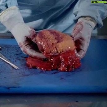 Carla Valentine - 4.3K Likes - Many moons ago (in 2016) I filmed an autopsy for a TV show called Obesity: The Post Mortem. The idea was to also make other episodes like Alcohol: The Post Mortem and smoking etc but unfortunately it never happened. It was a very interesting and insightful programme, but also very divisive. You can still see it in BBC iPlayer in the UK, it was on Netflix Canada and US at one point, and I'm sure it's even on YouTube. I'll put the link in my Linktree, above, and you can let me know your thoughts (Cadaver was donated for the purpose etc, of course)
#autopsy #autopsytechnician #pathology #obesitythepostmortem
