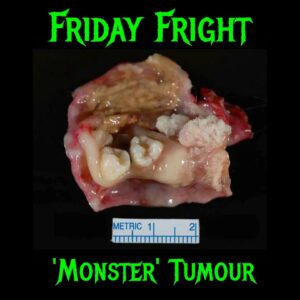Carla Valentine Instagram - The Halloween Countdown ("Carlaween") continues. This amazing image comes from Sanjay Mukhopadhyay (or @smlungpathguy on Twitter) and many of you will recognise this as a Dermoid Cyst or Teratoma. For those of you not quite so familiar I'll also post the one I have in my collection! – it’s as big as my head and similarly filled with hair, teeth, bone etc. It’s also known - for obvious reasons - as a "monster tumour" which is the Halloween connection. These tumours arise from the female ovary, usually. Ovaries are filled with totipotent stem cells which means cells that have the potential to be any tissue - after all, they'd usually form a baby. In the case of a teratoma they form a benign but strange 'monster tumour'. I’m posting this one is because Sanjay referred to something called the Rokitansky Protuberance in his tweet (it’s the deformed lumps from which the teeth etc usually arise) and I was surprised to have never heard the term. Many of you know I am a qualified autopsy technician and one of the names most bandied around in our studies is that of Carl Rokitansky (Physician/Pathologist, 1804 - 1878). He has quite a lot of medical terminology named after him and in fact when we eviscerate the deceased at autopsy using the ‘en masse’ method we call it the Rokitansky Method (even though that’s actually incorrect: Rokitansky dissected organs in situ.)
Anyway, the moral of the story is that I learned something new because of Sanjay and I guess no matter how much experience we have we are still learning!
#humanremains #carlaween #teratoma #dermoidcyst #rokitansky #rokitanskyprotuberance #carlrokitansky #halloween  #rokitanskymethod #halloweencountdown