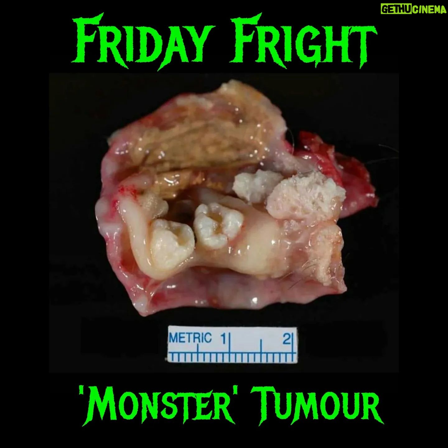 Carla Valentine - 514 Likes - The Halloween Countdown ("Carlaween") continues. This amazing image comes from Sanjay Mukhopadhyay (or @smlungpathguy on Twitter) and many of you will recognise this as a Dermoid Cyst or Teratoma. For those of you not quite so familiar I'll also post the one I have in my collection! – it’s as big as my head and similarly filled with hair, teeth, bone etc. It’s also known - for obvious reasons - as a "monster tumour" which is the Halloween connection. These tumours arise from the female ovary, usually. Ovaries are filled with totipotent stem cells which means cells that have the potential to be any tissue - after all, they'd usually form a baby. In the case of a teratoma they form a benign but strange 'monster tumour'. I’m posting this one is because Sanjay referred to something called the Rokitansky Protuberance in his tweet (it’s the deformed lumps from which the teeth etc usually arise) and I was surprised to have never heard the term. Many of you know I am a qualified autopsy technician and one of the names most bandied around in our studies is that of Carl Rokitansky (Physician/Pathologist, 1804 - 1878). He has quite a lot of medical terminology named after him and in fact when we eviscerate the deceased at autopsy using the ‘en masse’ method we call it the Rokitansky Method (even though that’s actually incorrect: Rokitansky dissected organs in situ.)
Anyway, the moral of the story is that I learned something new because of Sanjay and I guess no matter how much experience we have we are still learning!
#humanremains #carlaween #teratoma #dermoidcyst #rokitansky #rokitanskyprotuberance #carlrokitansky #halloween #rokitanskymethod #halloweencountdown