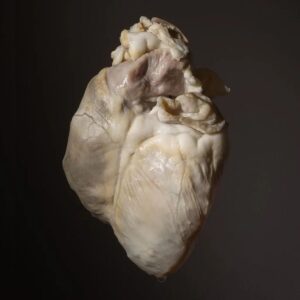 Carla Valentine Instagram - I post this a lot, but I find it fascinating: This pale, decellularized "ghost heart" is a little miracle for organ donation. The concept is a project started by molecular biologist Dr Doris Taylor, and which began around 2008 in the USA. A pig's heart is placed in a solution which "washes" or removes the cells that make up most of the tissue, leaving just a protein scaffold behind - and amazingly part of this "washing" process involves baby shampoo! The scaffold, a transparent extracellular matrix, is neutral meaning it won't be rejected by the new host: i.e. the person receiving the heart. After being re-filled with stem cells from the blood or bone marrow of the host, it's placed into a bioreactor and left to mature into a fully beating heart with a new 'identity'. This takes a lot of work and time and is now done in a sterile robotic chamber. The heart can then be transplanted into the recipient as if it was their own organ, eliminating the need for anti-rejection drugs and improving the post-transplant quality of life as less time is required in hospital. Dr Taylor left academia in 2020 and is currently working with private investors to bring her creation to the public. Human trials are on the way soon.
👻
I would absolutely LOVE to teach how to make these in a Saturday workshop (like I used to do with regular lamb heart preservation classes.) It would make an arresting little specimen and unusual gift. WHO WOULD LOVE THIS?! Tell me, in comments, if you'd like this or if you'd like me to start doing organ preservation classes again... 2024 may be the year we can increase public engagement events.
🤞
#valloween #valentinescountdown #valentinesday #valentine #humanremains #ghost #remains2beseen #anatomy #pathology #specimen #heart #hearttransplant #ghostheart #stemcells #organdonation #transplant