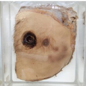 Carla Valentine Instagram - I'm currently more focused on the forensics specimens held in the collection I work at, because the last book I had published was about the forensics of Agatha Christie (and I'm starting work on a new one...watch this space!) This is a potted section of a man's torso (you can see the nipple, for context) with a gunshot wound. Archive Info: "caused by an old, large calibre service revolver which hadn't been cleaned or fired for many years and it was an accidental shooting, possibly because the ammunition was unstable. The combination of a barrel lined with corrosion & carbon deposits, together with old, corroded ammo proved to be deadly. It's theorised the gun went off due to jarring, so it wasn't an outright shooting. The rectangular stretch below the wound is from a dressing applied for a short while". 📸 is mine
#gun #gunshot #gunshotwound #forensics #ballistics #forensicballistics #humanremains #autopsy  #remains2beseen #anatomy #pathology #specimen #conservation #wetspecimen #anatomymuseum #pathologymuseum