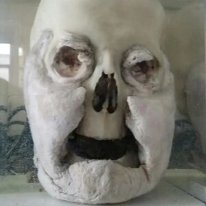 Carla Valentine Instagram - I've been working in a different gallery for a while (it's being cleared of hundreds of specimens for refurbishment, but the specimens *won't* go back into that space unfortunately.) So here's an oldie but a goodie from the main site:
🍖
I wonder if I can get the phrase "Steve the Beef" into a post? Yes I can indeed! Read on...
Adipocere: This gentleman is from the Forensic Collection at the Pathology Museum, dated around 1960s/70s and was discovered in the septic tank of a housing estate. The pathologists posited that perhaps he was the murder victim of a London gang rivalling The Krays, or The Krays themselves. Another reason for that theory is his teeth were knocked out, thereby making ID very difficult. This is a dry skull but it's preserved as what we call a 'wet specimen' in Kaiserling fluid as it has adipocere clinging to it. Adipocere - which literally translates into 'fatty wax' from the Greek 'adipose' meaning fat and 'cera' meaning wax - is a "soapy, waxy" substance which occurs in the deceased when the fat or adipose tissue of the body undergoes a process called 'saponification'. That process litterally means 'to turn into soap', although you wouldn't want to wash with it! I'd call it 'caseous' really, which means 'cheesy') Just as an aside, the actor Micheal Cera translated is Michael Wax, in the same way that Shia LaBeouf can be translated as "Steve the Beef" 😂😂😂 Anyway, this process usually happens if there is a high moisture content in the environment during decomposition, and can be useful to forensic investigators as it can preserve the tissue underneath. #adipocere #forensics #forensicscience #pathology #pathologymuseum #anatomy #anatomicalmuseum #anatomymuseum #histmed #wetspecimen #conservation #pottedspecimen #michaelcera #shialabeouf