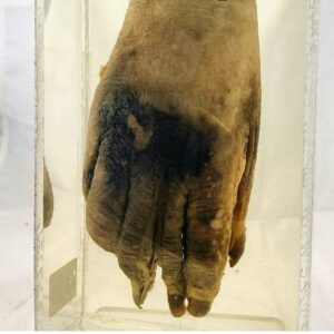Carla Valentine Instagram - My Carlaween countdown countinues with a variant on the theme of "zombie". This is a specimen of leprosy from our collection (apologies this is a very early photo from my path museum career!) Many years ago, according to the Catholic World Report, lepers were considered the "zombies" of the Middle East; the "walking dead" whose illness cut them off from the land of the living. Steve Parker, in his book Kill or Cure, states that because Catholic doctrine decreed lepers the Living Dead, they had no rights whatsoever. Nowadays the condition is instead known as Hansen's Disease as that term doesn't have the same negative religious connotations. (It's named after the Norwegian scientist Gerhard Hansen who discovered its causative agent in 1873.) Contrary to the much earlier belief that it was a punishment from God he showed it was caused by Mycobacterium Leprae, an unusual organism that is often artificially grown or 'cultured' on armadillos.
This leprosy specimen is from 1881: "a hand from a male native of Mauritius" and the split through one of the fingers was more than likely caused by exploratory tissue sampling. However what is visible is the shrivelliing of the fingers and spots of discolouration. Also caused in cases of Hansen's Disease are loss of sensation (which leads to injury) and deformity
#carlaweencountdown #humanremains #carlaween  #remains2beseen #anatomy #pathology #zombie #zombies #leprosy #halloweencountdown #halloween #thelivingdead