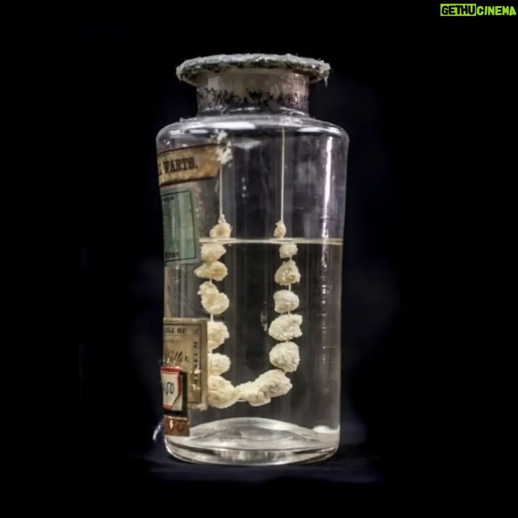 Carla Valentine - 648 Likes - 🧙 It's a necklace of genital warts for the Halloween/Carlaween post today, because many people associate warts with witches! This fascinating specimen of genital warts, strung together before being preserved in the 19th century, comes from @muttermuseum and their fantastic "Memento Mutter" website. Now, before you start wondering if this is some sort of Ed Gein precursor, or the work of a twisted weirdo, the site explains that the reason they're strung together is simple: it's for scientific study. It's easier to compare the size, shape and morphology of warts if they're next to each other rather than all at the bottom of a jar. At the museum I work in we have similar things but rather than strung together they're mounted on a backboard, something that was easier to do when acrylic started to be used for pots - rather than glass - in the 20th century. Also according to the Mutter site, an 8% solution of cocaine would be injected straight into the genitals to dull the pain of the agonising methods used to remove the warts, such as blades and "powerful caustics".
I know @muttermuseum is worried about it's future at the moment, so if you'd like to find out more about that and/or support them, then do check out their Instagram and @protectthemutter. It's an issue affecting other medical museums too, so your support really matters 🙏
#muttermuseum #pathology #pathologymuseum #histmed #mutter #mementomutter #carlaweencountdown #carlaween #halloweencountdown