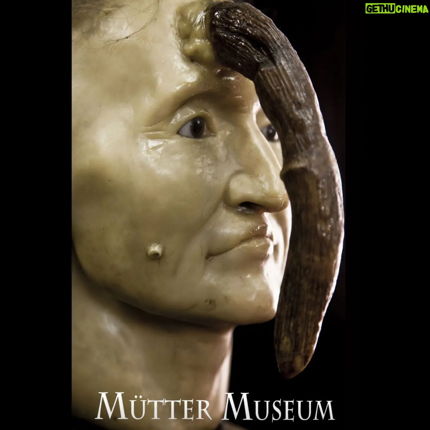 Carla Valentine - 515 Likes - Pop quiz! Apologies for the poor quality of the photo I took, but I've not been at the museum much recently and had to use an old image. Does anyone know what this potted specimen is?
•
It's a "human horn!" (Yes, I thought of Futurama too...)
The medical name for this condition is a cutaneous horn, as cutaneous means "relating to or affecting the skin", and in Latin it's Cornu Cutaneum.
It may also be called a keratin horn because these unusual growths are made from keratin, which is the same substance that makes up hair & nails in humans, and the oesophagus of rats. They are often benign but can sometimes be malignant and their cause is still unknown. Because they more commonly appear on the face, ears and backs of hands, and in those with fair skin, it's been suggested that there may be a connection with exposure to sunlight but there's also a theory they are related to the wart causing virus HPV. They can be removed fairly easily for those with access to a decent medical system.
•
As you can see from the 2nd slide, there are still people suffering from this affliction and it's not an archaic condition. The woman in the picture is a 69 yo who watched this horn develop over a period of 20 years. At the time this pic was taken the horn was 17cm long and was removed under general anaesthetic.
•
You can see from the final image that @muttermuseum in Philadelphia has an example of this in the form of a wax moulage. The woman depicted was called Madame Dimanche and she lived in 19th century France. Her horn was 25cm long!
•
We had a sudden period of "summer" here in the UK over the last fortnight so, if these horns are linked to sun damage, this is your reminder to always wear SPF, and if you have any unusual growths or moles that have recently changed in appearance, go and get it checked out!
•
#cutaneoushorn #medicine #medicalmuseum #pathology #muttermuseum #mutter #protectthemutter #histmed #pathologymuseum #wetspecimen #humanremains #skincancerawareness