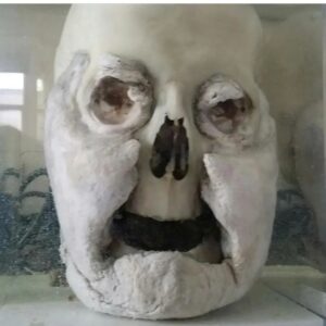 Carla Valentine Instagram - Hmmm, I wonder if I can get the phrase "Steve the Beef" into a post? Yes I can indeed! Read on...
Adipocere: This gentleman is from the Forensic Collection at the Pathology Museum, dated around 1960s/70s and was discovered in the septic tank of a housing estate. The pathologist/police posited that perhaps he was the murder victim of a London gang rivalling The Krays. A reason for that theory is his teeth were purposely knocked out, thereby making ID very difficult - typical gang MO. This is a dry skull but it's preserved as what we call a 'wet specimen' in Kaiserling fluid as it has adipocere clinging to it. Adipocere - which literally translates into 'fatty wax' from the Greek 'adipose' meaning fat and 'cera' meaning wax - is a "soapy, waxy" substance which occurs in the deceased when the fat or adipose tissue of the body undergoes a process called 'saponification'. That process litterally means 'to turn into soap', although you wouldn't want to wash with it! I'd call it 'caseous' really, which means 'cheesy') Just as an aside, the actor Micheal Cera translated is Michael Wax, in the same way that Shia LaBeouf can be translated as "Steve the Beef" 😂 Anyway, this process usually happens if there is a high moisture content in the environment during decomposition, and can be useful to forensic investigators as it can preserve the tissue underneath. On a more serious note, and very sadly, it happens to dead babies frequently because they have a higher fat. #adipocere #forensics #forensicscience #pathology #pathologymuseum #anatomy #anatomicalmuseum #anatomymuseum #histmed #wetspecimen #conservation #pottedspecimen #michaelcera #shialabeouf