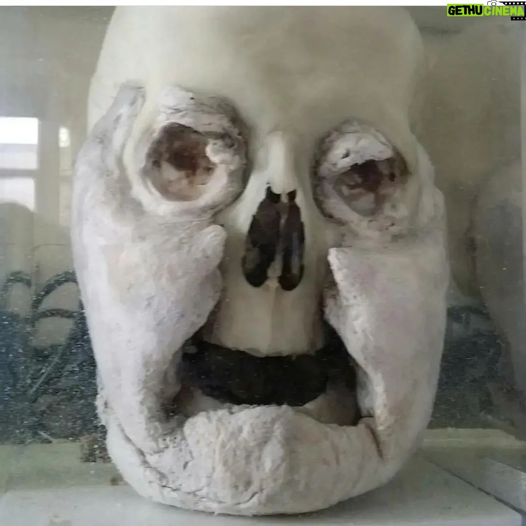 Carla Valentine - 1.1K Likes - Hmmm, I wonder if I can get the phrase "Steve the Beef" into a post? Yes I can indeed! Read on...
Adipocere: This gentleman is from the Forensic Collection at the Pathology Museum, dated around 1960s/70s and was discovered in the septic tank of a housing estate. The pathologist/police posited that perhaps he was the murder victim of a London gang rivalling The Krays. A reason for that theory is his teeth were purposely knocked out, thereby making ID very difficult - typical gang MO. This is a dry skull but it's preserved as what we call a 'wet specimen' in Kaiserling fluid as it has adipocere clinging to it. Adipocere - which literally translates into 'fatty wax' from the Greek 'adipose' meaning fat and 'cera' meaning wax - is a "soapy, waxy" substance which occurs in the deceased when the fat or adipose tissue of the body undergoes a process called 'saponification'. That process litterally means 'to turn into soap', although you wouldn't want to wash with it! I'd call it 'caseous' really, which means 'cheesy') Just as an aside, the actor Micheal Cera translated is Michael Wax, in the same way that Shia LaBeouf can be translated as "Steve the Beef" 😂 Anyway, this process usually happens if there is a high moisture content in the environment during decomposition, and can be useful to forensic investigators as it can preserve the tissue underneath. On a more serious note, and very sadly, it happens to dead babies frequently because they have a higher fat. #adipocere #forensics #forensicscience #pathology #pathologymuseum #anatomy #anatomicalmuseum #anatomymuseum #histmed #wetspecimen #conservation #pottedspecimen #michaelcera #shialabeouf