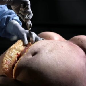Carla Valentine Instagram - Many moons ago (in 2016) I filmed an autopsy for a TV show called Obesity: The Post Mortem. The idea was to also make other episodes like Alcohol: The Post Mortem and smoking etc but unfortunately it never happened. It was a very interesting and insightful programme, but also very divisive. You can still see it in BBC iPlayer in the UK, it was on Netflix Canada and US at one point, and I'm sure it's even on YouTube. I'll put the link in my Linktree, above, and you can let me know your thoughts (Cadaver was donated for the purpose etc, of course)
#autopsy #autopsytechnician #pathology #obesitythepostmortem