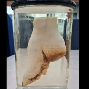Carla Valentine Instagram - Bound Foot of a Chinese woman (1862). Please tag @baileysarian because it would be AMAZING if she saw this following on from her Dark History video. 
🦶
The foot is shortened antero-posteriorly. The natural concavity of the sole is greatly increased. The bones are compressed and much smaller than their normal size. The toes are doubled down and distorted. The practice of binding feet in China began during the Tang dynasty (circa 950 AD) and continued as late as the 1870s. The process of creating these 'Lotus Feet' was started usually in the winter months when feet were numb and slightly less likely to feel pain. It began by soaking the feet of a young girl (around 2-5 years old – before the arch of the foot had a chance to develop fully) in warm animal blood in which herbs had been steeped. Toe nails were clipped, as far back as possible to prevent ingrowth and infection, and then a foot massage was given before the next step which involved breaking every toe except for the big toe. The arch of the foot was also forcibly broken. This was all done by pressing toes tightly down and into the sole of the foot and then binding them even tighter with bandages soaked into the blood and herb mixture. 
The procedure continued with unbinding (every couple of days), re-cutting toenails, soaking the feet to remove necrotic tissue, massaging broken bones then re-binding even tighter. As well as the more obvious problems of pain, the main issue with this techniques was infection due to ingrown toenails: many dropped off and were unable to grow back. Also, with circulation to the feet being compromised complications such as necrotic flesh were rife. However, this could be considered a benefit as it meant that toes would drop off and 'unwanted' flesh could be removed. In certain instances, girls with fleshier toes or larger feet risked having shards of glass or rusty nails inserted deliberately to cause infection and ultimately necrosis of tissue which could be sloughed away. Unfortunately this form of infection could lead to septic shock and death. #footbinding