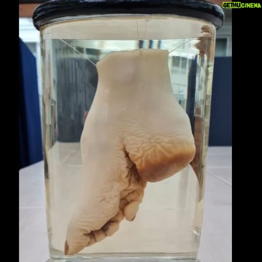 Carla Valentine - 385 Likes - Bound Foot of a Chinese woman (1862). Please tag @baileysarian because it would be AMAZING if she saw this following on from her Dark History video.
🦶
The foot is shortened antero-posteriorly. The natural concavity of the sole is greatly increased. The bones are compressed and much smaller than their normal size. The toes are doubled down and distorted. The practice of binding feet in China began during the Tang dynasty (circa 950 AD) and continued as late as the 1870s. The process of creating these 'Lotus Feet' was started usually in the winter months when feet were numb and slightly less likely to feel pain. It began by soaking the feet of a young girl (around 2-5 years old – before the arch of the foot had a chance to develop fully) in warm animal blood in which herbs had been steeped. Toe nails were clipped, as far back as possible to prevent ingrowth and infection, and then a foot massage was given before the next step which involved breaking every toe except for the big toe. The arch of the foot was also forcibly broken. This was all done by pressing toes tightly down and into the sole of the foot and then binding them even tighter with bandages soaked into the blood and herb mixture.
The procedure continued with unbinding (every couple of days), re-cutting toenails, soaking the feet to remove necrotic tissue, massaging broken bones then re-binding even tighter. As well as the more obvious problems of pain, the main issue with this techniques was infection due to ingrown toenails: many dropped off and were unable to grow back. Also, with circulation to the feet being compromised complications such as necrotic flesh were rife. However, this could be considered a benefit as it meant that toes would drop off and 'unwanted' flesh could be removed. In certain instances, girls with fleshier toes or larger feet risked having shards of glass or rusty nails inserted deliberately to cause infection and ultimately necrosis of tissue which could be sloughed away. Unfortunately this form of infection could lead to septic shock and death. #footbinding
