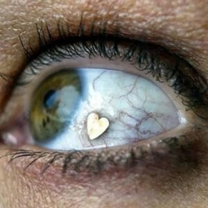 Carla Valentine Instagram - ❤️ Jeepers Creepers, where'd you get those peepers? From the Netherlands at a cost of about $3000, that's where...👀
This is an image of an extraocular implant; a very apt little heart! Willing participant for this *then* experimental process, Deborah Boer, had a platinum heart inserted within the superficial inerpalpebral conjunctiva of the eye. The procedure was first carried out, on 6 people in total, at Netherland's Institute for Innovative Ocular Surgery (NIOS) in 2002 as a new form of body modification. The process is now trademark (™️) as "Jewel Eye" and includes many shapes as well as hearts, such as stars, four-leaf clovers and more!
I have to say, it's not for me, although I think I'd choose this over having my sclera injected with ink, a la the lovely @graceneautral 🤦‍♀️ But it's heart shaped and it involves anatomy so it makes my Valentine theme ❤️
#remains2beseen #anatomy #valentinesday #bloodyvalentine #heart #valentine #eyepiercing #eyejewelry #eyejewellery #valentinecountdown