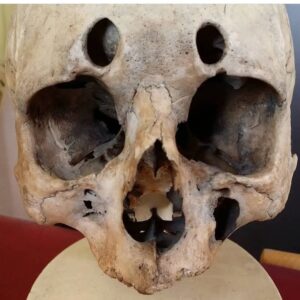 Carla Valentine Instagram - "Snot holes". I found this skull in my office a few years ago with no catalogue information and ended up putting a pic on Twitter to see if anyone could help identify the holes in the forehead. I didn't know if they were artificial or congenital or what. Not only did I find out what they were I also had a Doctor from the US contact me to say he *had* the whole skull catalogue! Incredible what can be found on the internet. Turns out these are trephining holes to purge mucus - quite common in the 18th Century. The power of social media! Sometimes it's on the side of good...💀 #humanremains #remainstobeseen #anatomy #pathology #specimen #conservation #histmed #skull #trephining #trepanning