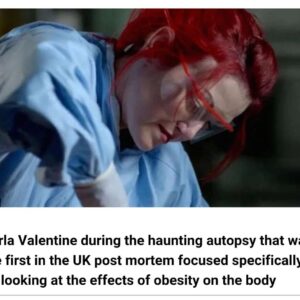 Carla Valentine Instagram - Many moons ago (in 2016) I filmed an autopsy for a TV show called Obesity: The Post Mortem. The idea was to also make other episodes like Alcohol: The Post Mortem and smoking etc but unfortunately it never happened. It was a very interesting and insightful programme, but also very divisive. You can still see it in BBC iPlayer in the UK, it was on Netflix Canada and US at one point, and I'm sure it's even on YouTube. I'll put the link in my Linktree, above, and you can let me know your thoughts (Cadaver was donated for the purpose etc, of course)
#autopsy #autopsytechnician #pathology #obesitythepostmortem