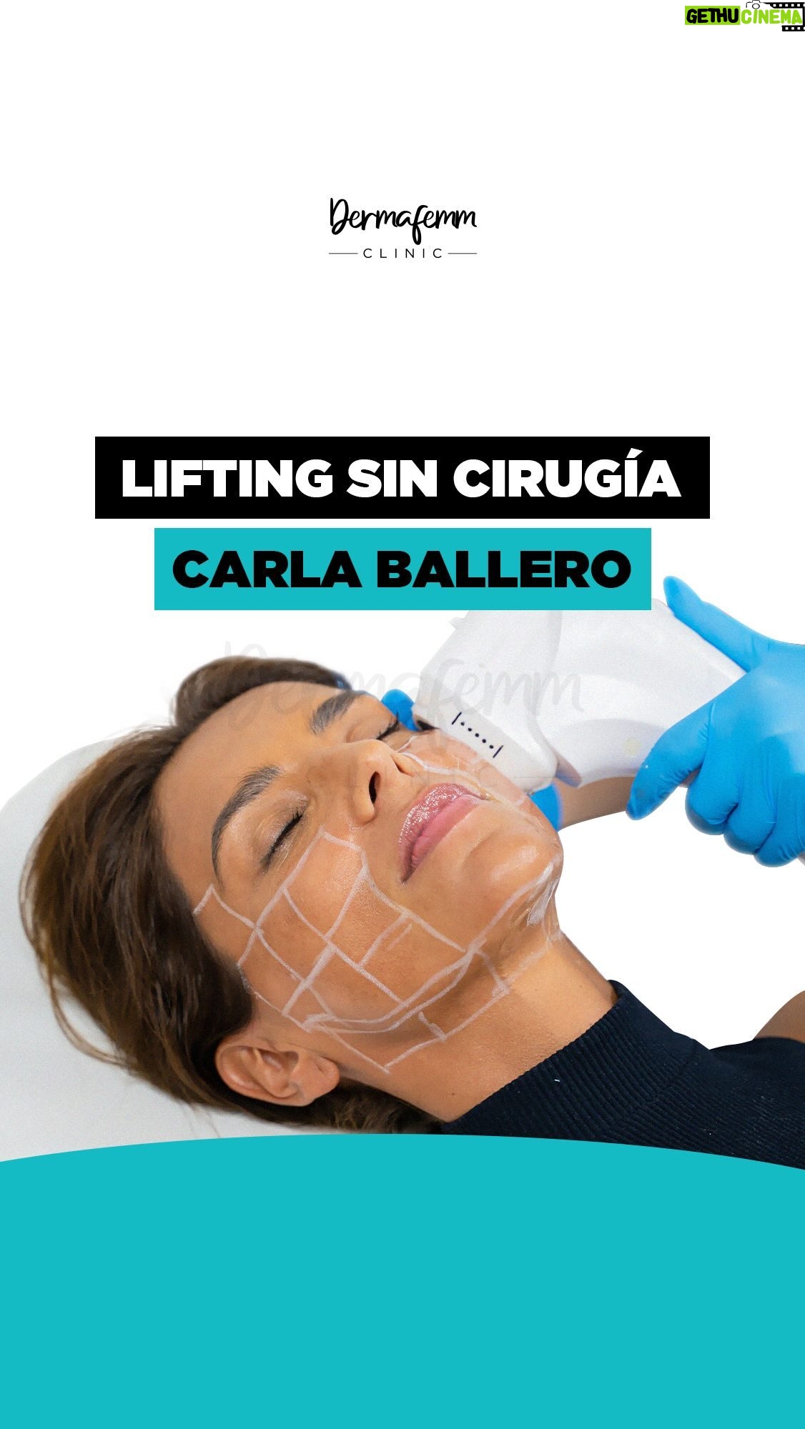 Carla Ballero - 2.5K Likes - Aplicación de lifting sin cirugĆa HIFU 4D facial en nuestra amiga @carlaballeroa š¤©š©·
Esta tecnologĆa nos permite realizar un efecto de lifting y de tensión en la piel con posible rejuvenecimiento š
Genera cambios mĆnimos inmediatos posterior a la primera sesión ā
ObtĆ©n resultados naturales sin necesidad de pasar por el quirófano ā
Comenta aquĆ tus necesidades y te asesoraremos š©š»āāļøš
”Agenda tu cita!
š² 569 4252 4673
š Las Condes.
#dermafemm_clinicš©š¼ā
#hifu #hifu4dfacial #liftingsincirugia #liftingfacial #dermafemm #rostrodefinido #adiosflacidez