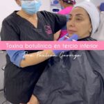 Carmen Gloria Arroyo Instagram - Antes de aplicar toxina botulínica es esencial evaluar tanto el tercio inferior como el superior . ¿Por qué? 🤔Porque existen músculos que ejercen mucha tracción hacia abajo, generando flacidez, arrugas en la piel y que “se nos caiga la cara”. ¡No dudes en contactarnos al 56930 025 592! 📲 Estamos aquí para resolver tus dudas. ✨