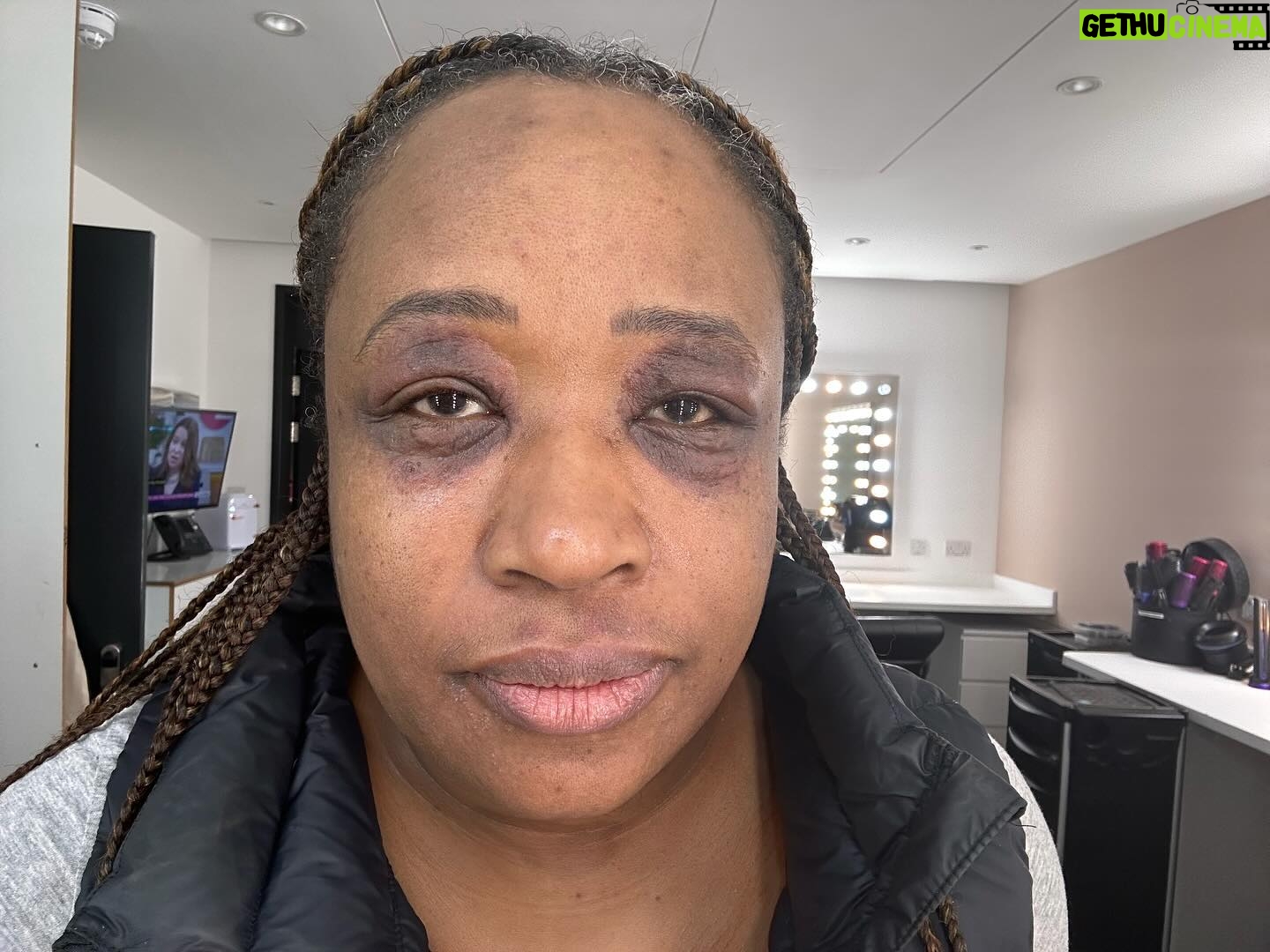 Charlene White - 13.6K Likes - Before the “ewww what’s wrong with her eyes!!” messages start flooding my inbox after @loosewomen , I’ve had an allergic reaction to something (and have had for months now) but it’s pretty bad this morning 😩. Could barely open my eyes at 3am.
But huge thank-you to Loose make-up’s @francescajordan for doing a stellar camouflage job and covering it up. And yes I know putting make-up on won’t help the situation, but it was too late to not come into work. Such is life.
Anyway, 👉🏾 swipe to see what Fran’s magic hands achieved. Very grateful ❤️.
(and yes, I’m booked in with a specialist this week… finally!)
