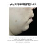 Choi Hee Instagram - 🛎️ KYYB 오픈 안내 🛎️ 늘어난 턱밑, 무너진 얼굴라인, 이중턱, 자주 붓는 얼굴이 고민이셨다면 킵의 NaDC크림을 추천합니다. 그동안 피부에 직접 침투, 흡수시킬 수가 없어 주사로 맞았던 지방분해성분 NaDC성분을 카이스트 박사진의 모아시스 기술로 이제는 피부를 통해 흡수시킬 수가 있어요. 저도 너무 바쁘고 또 주사는 붓고 멍들고 해서 시술이 고민되었는데 킵을 만나고 나서는 매일매일 편하게 관리해주고 있어요. 후기들을 보시면 아시겠지만 정말 얼굴라인이 많이 잡혔다, 고민이던 턱살이 줄었다, 얼굴 붓기가 빠졌다 등등의 찐 긍정적인 후기들이 대부분입니다. 저는 제가 판매하는 제품을 구매하셔서 모두 만족하고 잘 사용하셨으면 좋겠어요. 간혹 후기중에 (그런데 정말 후기 비율 중엔 아주 드문것도 신기해요. 보통 긍정 후기와 부정 후기가 섞여있기 마련인데, 킵은 부정적인 후기는 극소수더라구요..) 효과가 없다. 라고 하시는 분들도 계셨어요. 저는 이런 지방을 분해해준다는 셀룰라이트 크림부터 이것저것 아나운서 시절부터 쭈욱 사용해왔는데요.. 이런 기전은 처음 봅니다. 주사로 맞는 확실한 지방분해성분을 피부에 넣는데, 원래는 피부 도포로는 안들어가는 그 성분을 모아시스 기술로 분자구조를 재배열해 넣어주는 제품. 저는 이렇게 성분과 매커니즘이 효과가 없으면 사실 다른 제품들은 더욱 효과가 없다고 생각해요. 지방세포를 파괴해주는 성분이 들어가있는데 물론,, 우리가 더 잘 먹고 지방 세포를 자꾸 포동포동 살 찌우는 그 속도가 더 빠르다면…^^ 효과는 없을 수도 있어요. 파괴하는 속도보다 찌우는 속도가 더 빠르면요 …ㅎㅎ 그래서 평상시대로 관리하시면서 이크림을 꼭 써보세요. 후기에 넘쳐나는 찐 간증 후기들처럼… 뭔가 얼굴라인이 정리되고, 무너졌던 라인이 예뻐지고, 면적이 줄어들고 하는 효과를 느끼실 수 있을 거예요. 그리고 무엇보다 꾸준함이 답입니다! 그리고 5나노차저 (히알루론산 앰플)이 함께 묶여있는 구성이 있는데요. 저는 이 구성을 가장 추천해요. 왜냐면 이 앰플은,,, 킵에서 지방분해크림이 이렇게 뜨기 이전에 부동의 1위를 차지하고, 너무 많은 분들이 재구매, 또 재구매해주시는 제품이거든요. 매커니즘은 똑같습니다. 주사시술에선 고분자 히알루론산을 넣습니다. 왜냐, 히알루론산은 원래 고분자이고 그게 더 효과가 좋거든요. 그런데 주사 외에는 피부에 들어가질 못해서 저분자로 그동안은 쪼갰습니다. 그치만 우리에게는 모아시스 기술이 있지요. 모아시스기술로 고분자 히알루론산을 앰플로 넣어줍니다. 정말 끈적임없이 쏘옥 흡수되고요, 여러분이 가지고 계시는 첫 단계에 도포해주시면 됩니다. 속건조 고민이신 분들은 물론이고요.. 피부를 구성하는 주요성분인 히알루론산이 채워짐으로써 탄력과 톤에도 도움을 받으시는 분들이 진짜 많아요. 이건 찐 그분돈 그분산이라 실명은 못 말하지만, 대한민국 현재 가장 핫한 메이크업 아티스트분이 직접 구매하셔서 아이돌 메이크업할때 사용하시는 제품이에요. 그분은 공병에 담아 미스트로 사용하신다고해요. 이 제품 바르고 안바르고 메이크업 먹는 느낌도 완전 달라요. 킵은 단독 첫 공구입니다! 한번도 공구를 진행한 적이 없는 브랜드이고, 앞으로도 공구를 자주 진행할 계획이 전혀 없어요. 정말 좋은 기회로 공구를 가지고 오게 되었고, 역제안해서 뚫어온 브랜드입니다. 할인율도 너무 좋으니, (세일을 안해서 기존 고객분들은 다 제값주고 구매하셨어요.) 이 기회 챙겨가세요🤍
