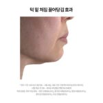 Choi Hee Instagram - 🛎️ KYYB 오픈 안내 🛎️ 늘어난 턱밑, 무너진 얼굴라인, 이중턱, 자주 붓는 얼굴이 고민이셨다면 킵의 NaDC크림을 추천합니다. 그동안 피부에 직접 침투, 흡수시킬 수가 없어 주사로 맞았던 지방분해성분 NaDC성분을 카이스트 박사진의 모아시스 기술로 이제는 피부를 통해 흡수시킬 수가 있어요. 저도 너무 바쁘고 또 주사는 붓고 멍들고 해서 시술이 고민되었는데 킵을 만나고 나서는 매일매일 편하게 관리해주고 있어요. 후기들을 보시면 아시겠지만 정말 얼굴라인이 많이 잡혔다, 고민이던 턱살이 줄었다, 얼굴 붓기가 빠졌다 등등의 찐 긍정적인 후기들이 대부분입니다. 저는 제가 판매하는 제품을 구매하셔서 모두 만족하고 잘 사용하셨으면 좋겠어요. 간혹 후기중에 (그런데 정말 후기 비율 중엔 아주 드문것도 신기해요. 보통 긍정 후기와 부정 후기가 섞여있기 마련인데, 킵은 부정적인 후기는 극소수더라구요..) 효과가 없다. 라고 하시는 분들도 계셨어요. 저는 이런 지방을 분해해준다는 셀룰라이트 크림부터 이것저것 아나운서 시절부터 쭈욱 사용해왔는데요.. 이런 기전은 처음 봅니다. 주사로 맞는 확실한 지방분해성분을 피부에 넣는데, 원래는 피부 도포로는 안들어가는 그 성분을 모아시스 기술로 분자구조를 재배열해 넣어주는 제품. 저는 이렇게 성분과 매커니즘이 효과가 없으면 사실 다른 제품들은 더욱 효과가 없다고 생각해요. 지방세포를 파괴해주는 성분이 들어가있는데 물론,, 우리가 더 잘 먹고 지방 세포를 자꾸 포동포동 살 찌우는 그 속도가 더 빠르다면…^^ 효과는 없을 수도 있어요. 파괴하는 속도보다 찌우는 속도가 더 빠르면요 …ㅎㅎ 그래서 평상시대로 관리하시면서 이크림을 꼭 써보세요. 후기에 넘쳐나는 찐 간증 후기들처럼… 뭔가 얼굴라인이 정리되고, 무너졌던 라인이 예뻐지고, 면적이 줄어들고 하는 효과를 느끼실 수 있을 거예요. 그리고 무엇보다 꾸준함이 답입니다! 그리고 5나노차저 (히알루론산 앰플)이 함께 묶여있는 구성이 있는데요. 저는 이 구성을 가장 추천해요. 왜냐면 이 앰플은,,, 킵에서 지방분해크림이 이렇게 뜨기 이전에 부동의 1위를 차지하고, 너무 많은 분들이 재구매, 또 재구매해주시는 제품이거든요. 매커니즘은 똑같습니다. 주사시술에선 고분자 히알루론산을 넣습니다. 왜냐, 히알루론산은 원래 고분자이고 그게 더 효과가 좋거든요. 그런데 주사 외에는 피부에 들어가질 못해서 저분자로 그동안은 쪼갰습니다. 그치만 우리에게는 모아시스 기술이 있지요. 모아시스기술로 고분자 히알루론산을 앰플로 넣어줍니다. 정말 끈적임없이 쏘옥 흡수되고요, 여러분이 가지고 계시는 첫 단계에 도포해주시면 됩니다. 속건조 고민이신 분들은 물론이고요.. 피부를 구성하는 주요성분인 히알루론산이 채워짐으로써 탄력과 톤에도 도움을 받으시는 분들이 진짜 많아요. 이건 찐 그분돈 그분산이라 실명은 못 말하지만, 대한민국 현재 가장 핫한 메이크업 아티스트분이 직접 구매하셔서 아이돌 메이크업할때 사용하시는 제품이에요. 그분은 공병에 담아 미스트로 사용하신다고해요. 이 제품 바르고 안바르고 메이크업 먹는 느낌도 완전 달라요. 킵은 단독 첫 공구입니다! 한번도 공구를 진행한 적이 없는 브랜드이고, 앞으로도 공구를 자주 진행할 계획이 전혀 없어요. 정말 좋은 기회로 공구를 가지고 오게 되었고, 역제안해서 뚫어온 브랜드입니다. 할인율도 너무 좋으니, (세일을 안해서 기존 고객분들은 다 제값주고 구매하셨어요.) 이 기회 챙겨가세요🤍