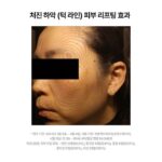 Choi Hee Instagram - 🛎️ KYYB 오픈 안내 🛎️ 늘어난 턱밑, 무너진 얼굴라인, 이중턱, 자주 붓는 얼굴이 고민이셨다면 킵의 NaDC크림을 추천합니다. 그동안 피부에 직접 침투, 흡수시킬 수가 없어 주사로 맞았던 지방분해성분 NaDC성분을 카이스트 박사진의 모아시스 기술로 이제는 피부를 통해 흡수시킬 수가 있어요. 저도 너무 바쁘고 또 주사는 붓고 멍들고 해서 시술이 고민되었는데 킵을 만나고 나서는 매일매일 편하게 관리해주고 있어요. 후기들을 보시면 아시겠지만 정말 얼굴라인이 많이 잡혔다, 고민이던 턱살이 줄었다, 얼굴 붓기가 빠졌다 등등의 찐 긍정적인 후기들이 대부분입니다. 저는 제가 판매하는 제품을 구매하셔서 모두 만족하고 잘 사용하셨으면 좋겠어요. 간혹 후기중에 (그런데 정말 후기 비율 중엔 아주 드문것도 신기해요. 보통 긍정 후기와 부정 후기가 섞여있기 마련인데, 킵은 부정적인 후기는 극소수더라구요..) 효과가 없다. 라고 하시는 분들도 계셨어요. 저는 이런 지방을 분해해준다는 셀룰라이트 크림부터 이것저것 아나운서 시절부터 쭈욱 사용해왔는데요.. 이런 기전은 처음 봅니다. 주사로 맞는 확실한 지방분해성분을 피부에 넣는데, 원래는 피부 도포로는 안들어가는 그 성분을 모아시스 기술로 분자구조를 재배열해 넣어주는 제품. 저는 이렇게 성분과 매커니즘이 효과가 없으면 사실 다른 제품들은 더욱 효과가 없다고 생각해요. 지방세포를 파괴해주는 성분이 들어가있는데 물론,, 우리가 더 잘 먹고 지방 세포를 자꾸 포동포동 살 찌우는 그 속도가 더 빠르다면…^^ 효과는 없을 수도 있어요. 파괴하는 속도보다 찌우는 속도가 더 빠르면요 …ㅎㅎ 그래서 평상시대로 관리하시면서 이크림을 꼭 써보세요. 후기에 넘쳐나는 찐 간증 후기들처럼… 뭔가 얼굴라인이 정리되고, 무너졌던 라인이 예뻐지고, 면적이 줄어들고 하는 효과를 느끼실 수 있을 거예요. 그리고 무엇보다 꾸준함이 답입니다! 그리고 5나노차저 (히알루론산 앰플)이 함께 묶여있는 구성이 있는데요. 저는 이 구성을 가장 추천해요. 왜냐면 이 앰플은,,, 킵에서 지방분해크림이 이렇게 뜨기 이전에 부동의 1위를 차지하고, 너무 많은 분들이 재구매, 또 재구매해주시는 제품이거든요. 매커니즘은 똑같습니다. 주사시술에선 고분자 히알루론산을 넣습니다. 왜냐, 히알루론산은 원래 고분자이고 그게 더 효과가 좋거든요. 그런데 주사 외에는 피부에 들어가질 못해서 저분자로 그동안은 쪼갰습니다. 그치만 우리에게는 모아시스 기술이 있지요. 모아시스기술로 고분자 히알루론산을 앰플로 넣어줍니다. 정말 끈적임없이 쏘옥 흡수되고요, 여러분이 가지고 계시는 첫 단계에 도포해주시면 됩니다. 속건조 고민이신 분들은 물론이고요.. 피부를 구성하는 주요성분인 히알루론산이 채워짐으로써 탄력과 톤에도 도움을 받으시는 분들이 진짜 많아요. 이건 찐 그분돈 그분산이라 실명은 못 말하지만, 대한민국 현재 가장 핫한 메이크업 아티스트분이 직접 구매하셔서 아이돌 메이크업할때 사용하시는 제품이에요. 그분은 공병에 담아 미스트로 사용하신다고해요. 이 제품 바르고 안바르고 메이크업 먹는 느낌도 완전 달라요. 킵은 단독 첫 공구입니다! 한번도 공구를 진행한 적이 없는 브랜드이고, 앞으로도 공구를 자주 진행할 계획이 전혀 없어요. 정말 좋은 기회로 공구를 가지고 오게 되었고, 역제안해서 뚫어온 브랜드입니다. 할인율도 너무 좋으니, (세일을 안해서 기존 고객분들은 다 제값주고 구매하셨어요.) 이 기회 챙겨가세요🤍