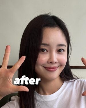 Choi Seol-hwa Instagram - #공구예정 비포 에프터 가져왔어요..!
일부러 포토샵 하나도 안했어요🧸
진쫘 보여주고싶지 않은 모습들이지만..😊
저는 볼꺼짐도 있었고 광대에 살이 많은 편이라 무거워서 쳐짐도 좀 있고 턱 하부에 뭉통거리는 살들도 있었어요!
그래서 소개 받아서 작은얼굴 마사지 받으러 갔다가 하이퍼라는 레이저리프팅 기계가 있는데 울세라와 비슷한 효과가 있는데 훨씬 저렴해서 두가지 관리 한 번이 받고 턱 하부 살과 볼꺼짐 개선돼서 바로 그 다음주에 또 받으러 갔잖아요!

효과가 너무 좋은게 어제 엄마가 제 얼굴 오랜만에 보고 변했다고 하도라고요.
진짜 200% 만족‼️

어제까지 네고 하다가 최대 33%까지 할인 받아왔어요😍😍 너무 다행이에요ㅠ 저에게도🩵
1-2주에 1회씩 무조건 가야겠어요!

위치는 청담동이에요!
황금희 에스테틱 작은얼굴관리 하어퍼 레이저리프팅 6/3~6/7까지 공구하니까 
관리하는거 좋아하시는 분들 무조건 겟하셔야할 타이밍🩵