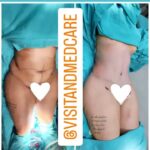 Dakota Tárraga Instagram - Quiero agradecer a la clínica @visitandmedcare por el cambio tan brutal que han hecho realizado en mi cuerpo. También a @nikitaofficial.sp por asesorarme y presentarme a nuestro queridísimo doctor. Daros cuenta, que llevo 9 dias operada, estoy súper hinchada, pero a la vez súper contenta 😌. Y como no a mi gente que siempre han estado apoyándome en todo. Cualquier cosita podéis preguntarme ♥️ @visitandmedcare ♥️♥️
