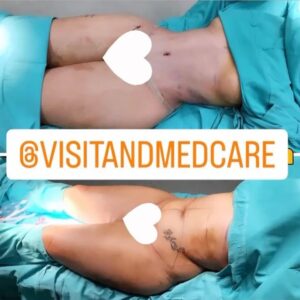 Dakota Tárraga Instagram - Quiero agradecer a la clínica @visitandmedcare por el cambio tan brutal que han hecho realizado en mi cuerpo. También a @nikitaofficial.sp por asesorarme y presentarme a nuestro queridísimo doctor. Daros cuenta, que llevo 9 dias operada, estoy súper hinchada, pero a la vez súper contenta 😌. Y como no a mi gente que siempre han estado apoyándome en todo. Cualquier cosita podéis preguntarme ♥️ @visitandmedcare ♥️♥️