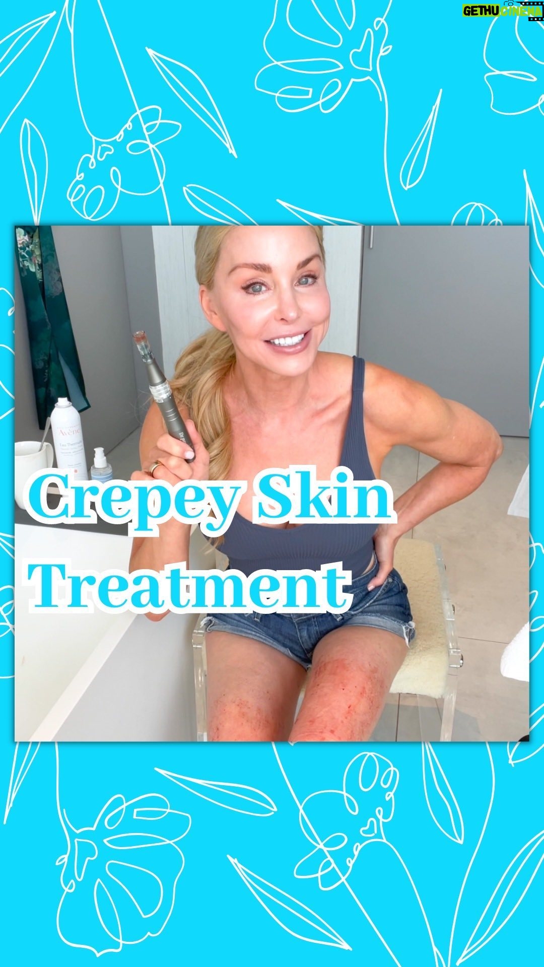 Darnell Cox - 644 Likes - Over 40? Over 50? And bothered by Crepey Skin?
Microneedling at-home is my top treatment for crepey skin!
Microneedling creates microtraumas which call on our own body to create collagen and elastin.
Microneedling reduces⬇️fine lines and wrinkles, tightens skin, and resurfaces.
At 55 years old, I have crepey skin, and it’s not just on my eyelids 😳, but I microneedle like a champ, targeting🎯every crepey area!
You can too!
➡️ Join the LIVE YOUNG IG subscriber Club for exclusive content and weekly microneedling tutorials. 🤗💕
➡️ Comment or DM me “Skincare” for a free, printable, at-home healthy aging gadgets monthly treatment schedule when you sign up for my weekly newsletter. 💌
#Over50SkinCare #TightenSkin #Microneedling #CrepeySkin