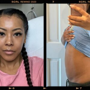 Denyce Lawton Instagram - 🥹🙏🏽🙌🏽 This week, I got an early Christmas present… I got the quality of my life back! #fibroids 

FULL STORY IN SLIDES! 👈🏽

DISCLAIMER: I am not discouraging anyone from proceeding with their holistic route, but for me & every single person that I personally know who suffered, we all felt scammed, and it did nothing but cause more stress & pain than help. 

Trying to put everything Ive endured over the last 6 yrs in a single post is impossible, but those who are close to me know how much Ive suffered from these damned things lol & anyone suffering from fibroids know as well. No amount of vegan or raw vegan lifestyle or meditation to reduce stress, was going to shrink or minimize the amount of fibroids I had. Did the remedies I experimented with help reduce inflammation & pain occasionally? Yes, but in NO way did they shrink or get rid of anything. 

All in all, I wanted to share a little about my journey in hopes that it will inspire someone to take care of themselves a lot better with diet, reduced stress, & to do proper research on what procedure is best for you just as much as which doctor serves YOU the best! I literally went to 13 doctors & did not allow these non-African-American people to tell me that it was impossible for me to have children. (IYKYK 🥴🙄) And it wasn’t because I was trying to be stubborn or that I did not believe all of these people because I thought I knew better than them. 11 of those doctors never even examined me!! Many of those doctors ignored my symptoms, and refused to acknowledge that the pain & suffering I was enduring Was real. I was told numerous times I DID NOT have fibroids and they were just cysts or polyps!!! And because of that, I refused to accept anything they had to say. And so, I went back to the person who believed me 8 YRS ago, & without hesitation, protected & supported me, and did it with such compassion and professionalism, & I would 100% trust my life with him every single time. From going out of your way to examine me to not sacrificing my body by removing the massive ones in whole parts for the bragging rights and everything in between!! 🙌🏽 THANK YOU GOD 🙌🏽 & Dr. Lizardo —->>. @obgdc 🫶🏽🫶🏽🙌🏽