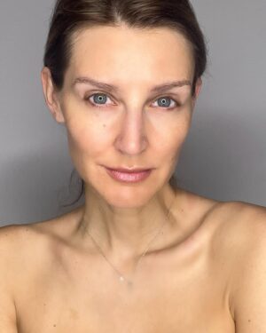 Diana Pereira Instagram - No makeup, no filter , apenas o tratamento laser da @dra.ritaseco na @galerieclinic , nem todos os tratamentos são iguais e todos podemos reagir de maneiras diferentes , por isso aconselha-te sempre com um profissional qualificado . A minha pele só confio à dr Rita Seco . A primeira foto foi o resultado final . A outras foi a evolução.