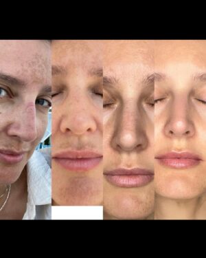 Diana Pereira Instagram - No makeup, no filter , apenas o tratamento laser da @dra.ritaseco na @galerieclinic , nem todos os tratamentos são iguais e todos podemos reagir de maneiras diferentes , por isso aconselha-te sempre com um profissional qualificado . A minha pele só confio à dr Rita Seco . A primeira foto foi o resultado final . A outras foi a evolução.
