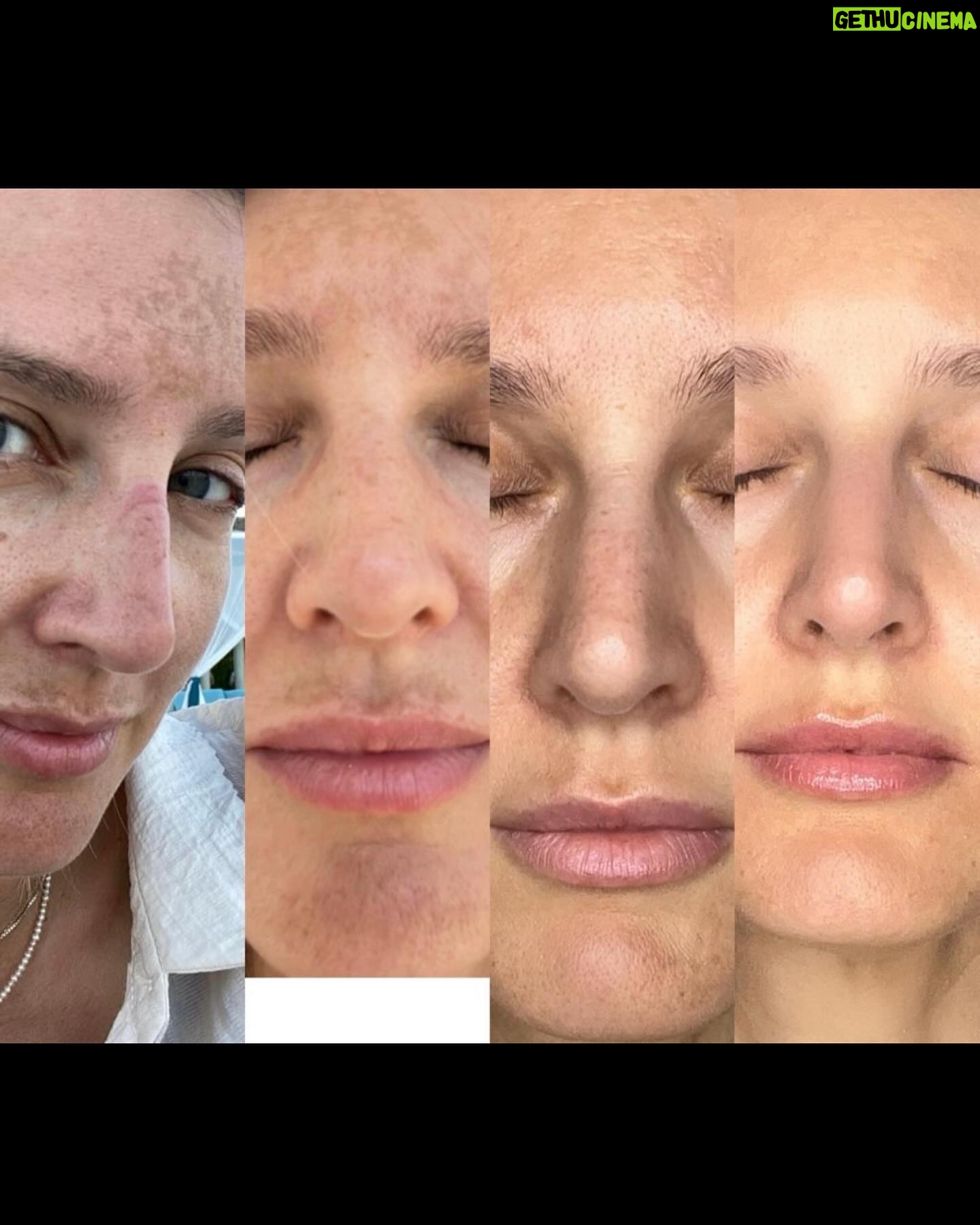 Diana Pereira - 1.4K Likes - No makeup, no filter , apenas o tratamento laser da @dra.ritaseco na @galerieclinic , nem todos os tratamentos são iguais e todos podemos reagir de maneiras diferentes , por isso aconselha-te sempre com um profissional qualificado . A minha pele só confio à dr Rita Seco . A primeira foto foi o resultado final . A outras foi a evolução.
