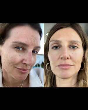 Diana Pereira Instagram - No makeup, no filter , apenas o tratamento laser da @dra.ritaseco na @galerieclinic , nem todos os tratamentos são iguais e todos podemos reagir de maneiras diferentes , por isso aconselha-te sempre com um profissional qualificado . A minha pele só confio à dr Rita Seco . A primeira foto foi o resultado final . A outras foi a evolução.
