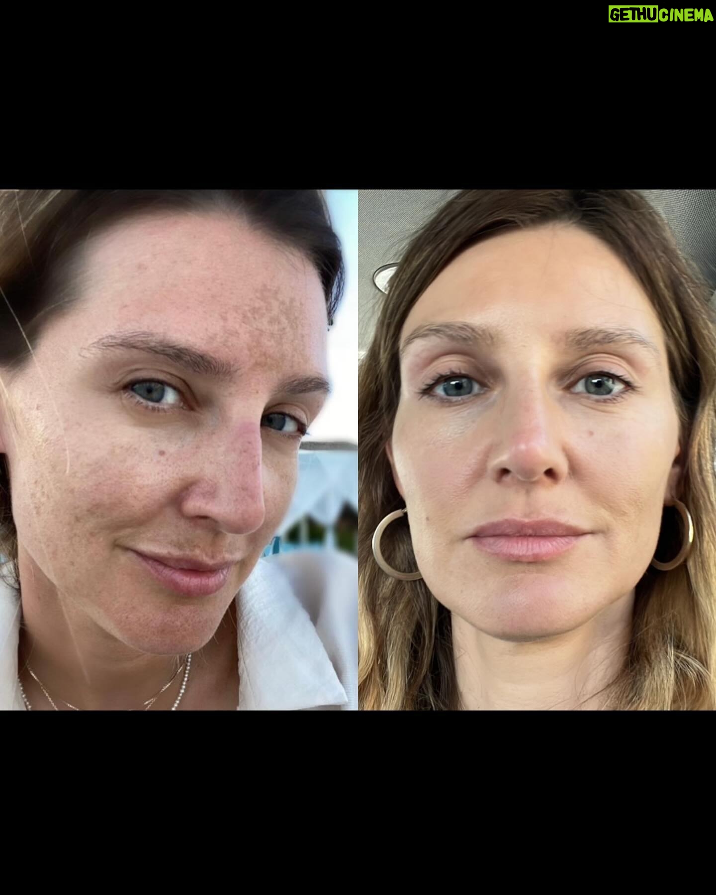 Diana Pereira - 1.4K Likes - No makeup, no filter , apenas o tratamento laser da @dra.ritaseco na @galerieclinic , nem todos os tratamentos são iguais e todos podemos reagir de maneiras diferentes , por isso aconselha-te sempre com um profissional qualificado . A minha pele só confio à dr Rita Seco . A primeira foto foi o resultado final . A outras foi a evolução.