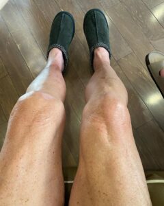 Dot-Marie Jones Instagram - I haven’t post anything about my knee replacement. I know my girl @bridgettcjones had but wanted to as well. My knee was a mess and this was the 8th surgery on my left one. I think I got my miles out of it. 9-12-23 was surgery! Have had some very bad days but slowly getting better! Thank you @bridgettcjones for being an amazing nurse and taking good care of me . I love you forever and always. I made that fancy cup and stuff holder for my Walker!!! Jealous 😉love y’all! I’ll keep y’all up to date! Today is day 8. Ya don’t count the day ya had the surgery cause ya don’t!!!