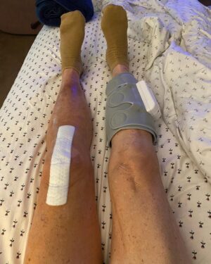 Dot-Marie Jones Instagram - I haven’t post anything about my knee replacement. I know my girl @bridgettcjones had but wanted to as well. My knee was a mess and this was the 8th surgery on my left one. I think I got my miles out of it. 9-12-23 was surgery! Have had some very bad days but slowly getting better! Thank you @bridgettcjones for being an amazing nurse and taking good care of me . I love you forever and always.  I made that fancy cup and stuff holder for my Walker!!! Jealous 😉love y’all! I’ll keep y’all up to date! Today is day 8. Ya don’t count the day ya had the surgery cause ya don’t!!!