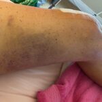 Dot-Marie Jones Instagram - I haven’t post anything about my knee replacement. I know my girl @bridgettcjones had but wanted to as well. My knee was a mess and this was the 8th surgery on my left one. I think I got my miles out of it. 9-12-23 was surgery! Have had some very bad days but slowly getting better! Thank you @bridgettcjones for being an amazing nurse and taking good care of me . I love you forever and always. I made that fancy cup and stuff holder for my Walker!!! Jealous 😉love y’all! I’ll keep y’all up to date! Today is day 8. Ya don’t count the day ya had the surgery cause ya don’t!!!