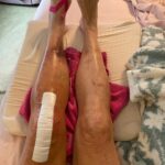 Dot-Marie Jones Instagram - I haven’t post anything about my knee replacement. I know my girl @bridgettcjones had but wanted to as well. My knee was a mess and this was the 8th surgery on my left one. I think I got my miles out of it. 9-12-23 was surgery! Have had some very bad days but slowly getting better! Thank you @bridgettcjones for being an amazing nurse and taking good care of me . I love you forever and always. I made that fancy cup and stuff holder for my Walker!!! Jealous 😉love y’all! I’ll keep y’all up to date! Today is day 8. Ya don’t count the day ya had the surgery cause ya don’t!!!
