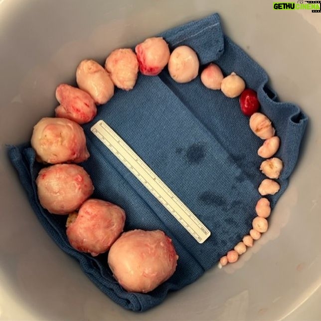 Erica Chidi Cohen - 6.6K Likes - it's been three weeks since my abdominal myomectomy. my team at @uclahealth took amazing care of me and i don't take that for granted, especially as a black woman. they removed 23 fibroids of every shape and size. ⚠️content warning⚠️ if you're not squeamish—swipe through for a closer look. all together my fibroids weighed around 500 grams—approximately the weight of a six-month old fetus.
recovery has been hard. instead of pushing through the pain, i've had to slow down and listen to my body literally demand that i do less. it's been uncomfortable to surrender and face how attached i am to being productive. i've had to rediscover my value outside of the framework of achievement. this forced stillness will be one of my greatest teachers. it's a portal for deep bodily and psychic change—a chance to see everything differently. more on the surgery and recovery process as i continue to heal but today i'm joyful, fibroid-free and finally back at home in my body. #itsallinmygut