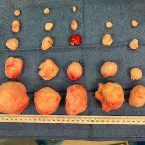 Erica Chidi Cohen Instagram - it's been three weeks since my abdominal myomectomy. my team at @uclahealth took amazing care of me and i don't take that for granted, especially as a black woman. they removed 23 fibroids of every shape and size. ⚠️content warning⚠️ if you're not squeamish—swipe through for a closer look. all together my fibroids weighed around 500 grams—approximately the weight of a six-month old fetus. 

recovery has been hard. instead of pushing through the pain, i've had to slow down and listen to my body literally demand that i do less. it's been uncomfortable to surrender and face how attached i am to being productive. i've had to rediscover my value outside of the framework of achievement. this forced stillness will be one of my greatest teachers. it's a portal for deep bodily and psychic change—a chance to see everything differently. more on the surgery and recovery process as i continue to heal but today i'm joyful, fibroid-free and finally back at home in my body. #itsallinmygut
