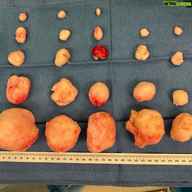 Erica Chidi Cohen - 6.6K Likes - it's been three weeks since my abdominal myomectomy. my team at @uclahealth took amazing care of me and i don't take that for granted, especially as a black woman. they removed 23 fibroids of every shape and size. ⚠️content warning⚠️ if you're not squeamish—swipe through for a closer look. all together my fibroids weighed around 500 grams—approximately the weight of a six-month old fetus.
recovery has been hard. instead of pushing through the pain, i've had to slow down and listen to my body literally demand that i do less. it's been uncomfortable to surrender and face how attached i am to being productive. i've had to rediscover my value outside of the framework of achievement. this forced stillness will be one of my greatest teachers. it's a portal for deep bodily and psychic change—a chance to see everything differently. more on the surgery and recovery process as i continue to heal but today i'm joyful, fibroid-free and finally back at home in my body. #itsallinmygut