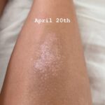 Eve Torres Instagram – One of the most significant choices this year was to have my breast implants removed, and taking steps to address my stress, auto immune, digestive, and skin issues. I had inclinations that they could be related to my implants, and more than 6 months later, although recovery was anything but easy, I couldn’t be happier with my choice. While many of my symptoms weren’t “measurable” my psoriasis was one that was clearly visible from the outside. After 10 years of persistent flare ups which had never naturally resolved, my psoriasis scarred over within 4 months of surgery. 

I have had no digestive flare-ups since my surgery, and I feel like my body is on my side. Everyone’s story is different, but I’m glad my story went this way. 

This was a major step in the right direction, but needed to be followed up with other proactive health choices. I’ve been doing cold immersion and sauna about 4x a week, and since I can’t use technology during these times, it has also forced some needed time for breathing and just staying still. 

There are tons of other missteps and habits that need breaking and building, but I’m proud of these steps I took this year for me.