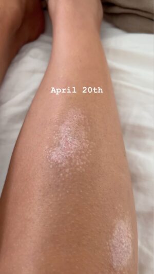 Eve Torres Instagram - One of the most significant choices this year was to have my breast implants removed, and taking steps to address my stress, auto immune, digestive, and skin issues. I had inclinations that they could be related to my implants, and more than 6 months later, although recovery was anything but easy, I couldn’t be happier with my choice. While many of my symptoms weren’t “measurable” my psoriasis was one that was clearly visible from the outside. After 10 years of persistent flare ups which had never naturally resolved, my psoriasis scarred over within 4 months of surgery. 

I have had no digestive flare-ups since my surgery, and I feel like my body is on my side. Everyone’s story is different, but I’m glad my story went this way. 

This was a major step in the right direction, but needed to be followed up with other proactive health choices. I’ve been doing cold immersion and sauna about 4x a week, and since I can’t use technology during these times, it has also forced some needed time for breathing and just staying still. 

There are tons of other missteps and habits that need breaking and building, but I’m proud of these steps I took this year for me.