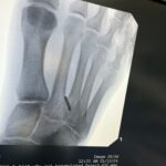 Felicity Palmateer Instagram – New year. New foot 🫠

Didn’t think I needed anymore character development just yet… but here we are… I know what it feels like to fold my entire foot backwards – don’t recommend it. 

Getting injured sucks. But being injured, away from your loved ones and getting surgery in a different country to home is pretty daunting. Extremely grateful to my sis @courtneyconlogue who’s taken me on as her patient and made me feel like family. @fredericksdaughter – just thank you 🖤 I couldn’t have done this without you women. To the people that have been on the other end of the phone and provided me with lots of free therapy – I love you all so much. 

MVP’s go to @drwarreng & Dr Harris who made this last week as pain free and as smooth as can be. I can’t express how grateful I am 🙏🏽

After last year’s season, I was geared up for something bigger, feeling the most mentally, physically, and emotionally prepared I’d ever been for a big wave season. I’m not sure when I’ll be back yet but it’s heartbreaking to not have the chance to make the most of it. 

Send Netflix reccos please 😂