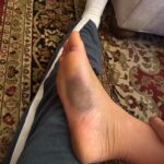 Felicity Palmateer Instagram – New year. New foot 🫠

Didn’t think I needed anymore character development just yet… but here we are… I know what it feels like to fold my entire foot backwards – don’t recommend it. 

Getting injured sucks. But being injured, away from your loved ones and getting surgery in a different country to home is pretty daunting. Extremely grateful to my sis @courtneyconlogue who’s taken me on as her patient and made me feel like family. @fredericksdaughter – just thank you 🖤 I couldn’t have done this without you women. To the people that have been on the other end of the phone and provided me with lots of free therapy – I love you all so much. 

MVP’s go to @drwarreng & Dr Harris who made this last week as pain free and as smooth as can be. I can’t express how grateful I am 🙏🏽

After last year’s season, I was geared up for something bigger, feeling the most mentally, physically, and emotionally prepared I’d ever been for a big wave season. I’m not sure when I’ll be back yet but it’s heartbreaking to not have the chance to make the most of it. 

Send Netflix reccos please 😂
